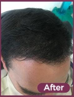 PRP After